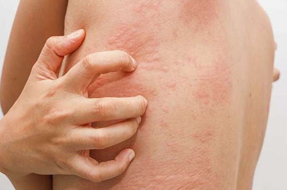К чему снится аллергия на лице или теле — 45 толкований из разных сонников - «Сонник»