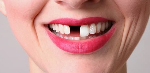К чему снятся золотые зубы у себя или у другого человека: толкование сонника - «Сонник»