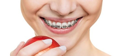 К чему снятся брекеты на зубах — 40 толкований из разных сонников - «Сонник»