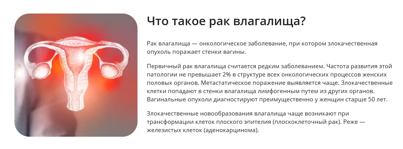 Рак влагалища: причины, симптомы и стадии заболевания